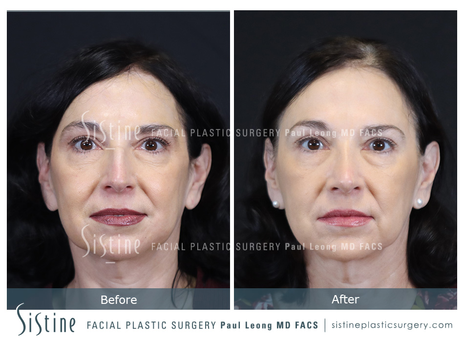 Rhinoplasty Before and After | Sistine Facial Plastic Surgery
