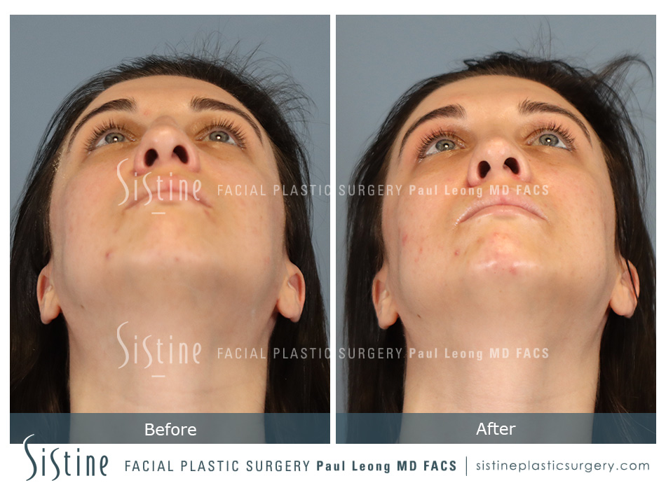Nose Changes With Age - Preoperative View | Dr. Paul Leong