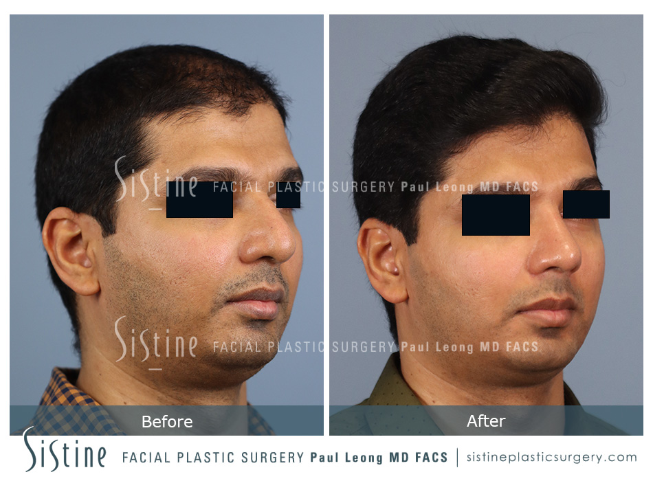 Rhinoplasty Functional - Patient Preoperative View | Dr. Paul Leong, Pittsburgh PA