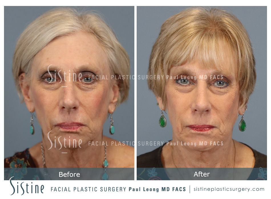 Rhinoplasty Recovery Photos - Preoperative Image | Dr. Paul Leong, Pittsburgh PA