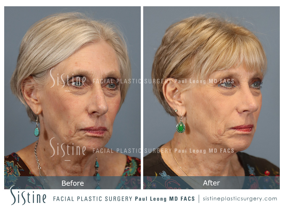 Rhinoplasty Functional - Patient Preoperative View | Dr. Paul Leong, Pittsburgh PA