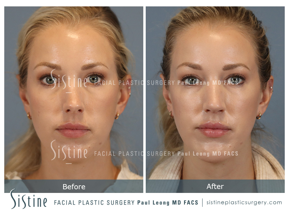 Rhinoplasty Surgery - Preoperative View | Sistine Facial Plastic Surgery