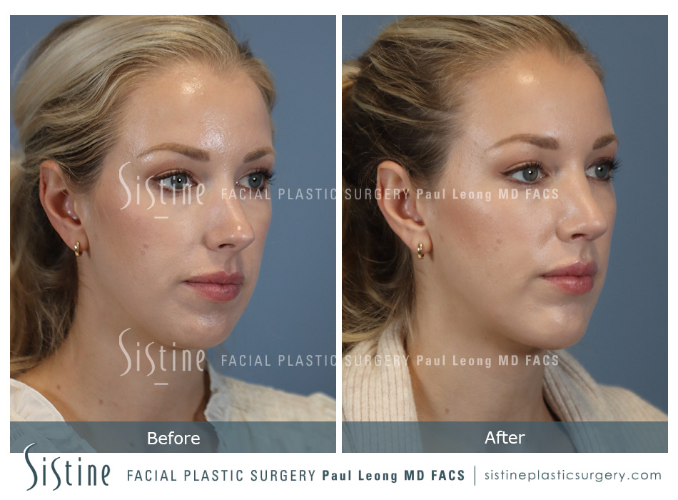 Rhinoplasty Surgery Wexford PA - Preoperative View | Sistine Facial Plastic Surgery