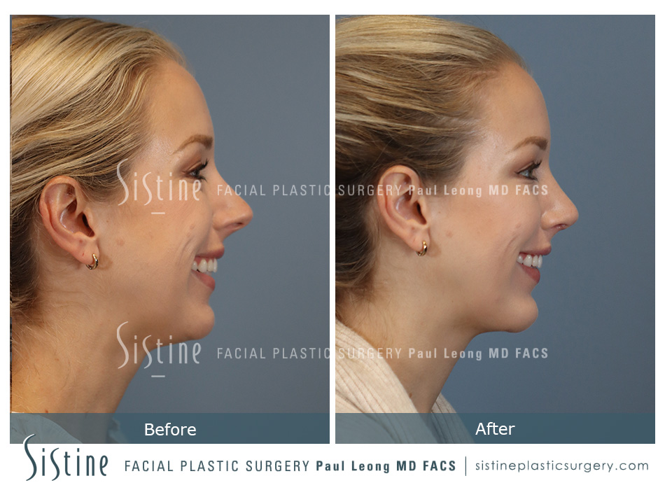 Tip Rhinoplasty - Preoperative Image | Dr. Paul Leong - Pittsburgh PA