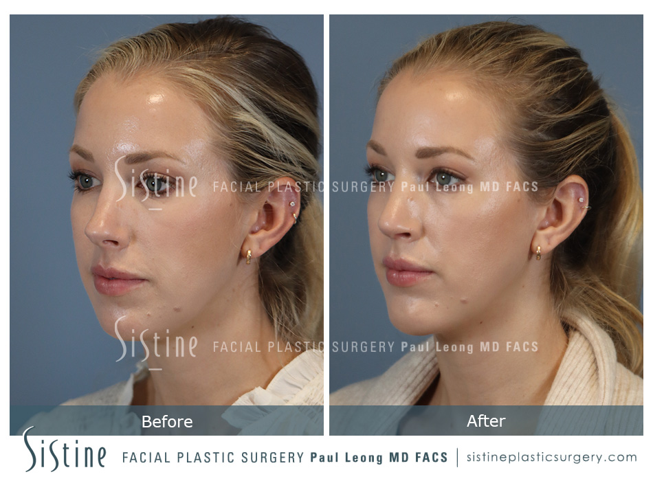 Highland Park Pittsburgh Rhinoplasty Surgery | Preoperative View | Dr. Paul Leong 