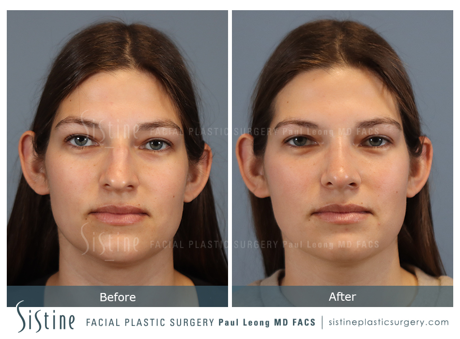 Nasal Tip Rotation - Preoperative Image | Sistine Facial Plastic Surgery