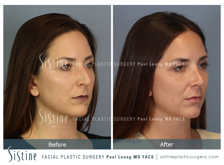 Pictures of Nose Jobs - Preoperative Left Oblique View | Dr. Paul Leong