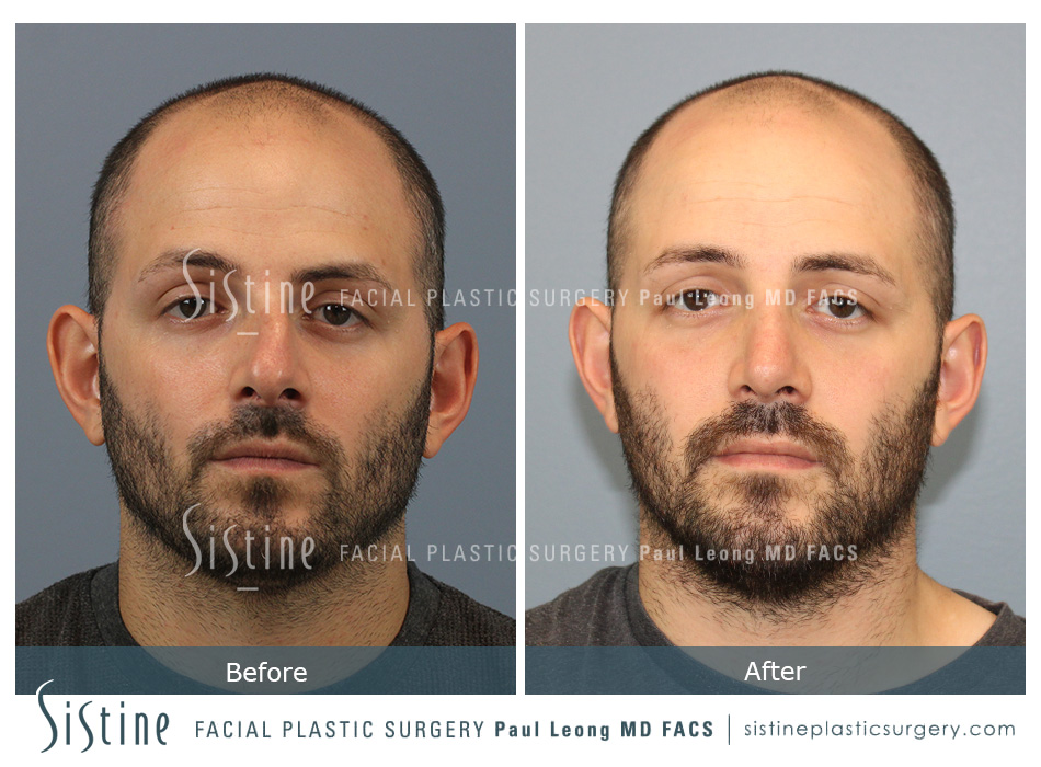 Pittsburgh Nose Job - Right Lateral Preoperative View | Dr. Paul Leong