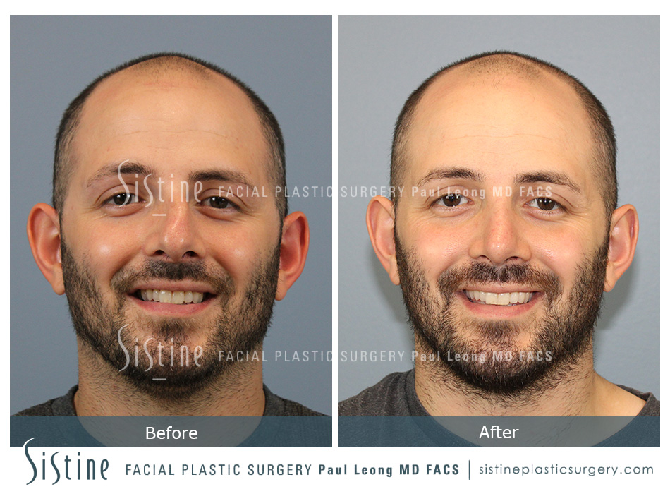 Rhinoplasty Septum Repair - Left Oblique Preoperative View | Sistine Facial Plastic Surgery