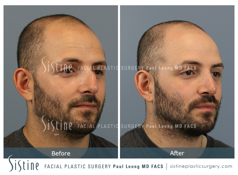 Nose Reshaping Pittsburgh | Frontal Preoperative View | Paul Leong MD