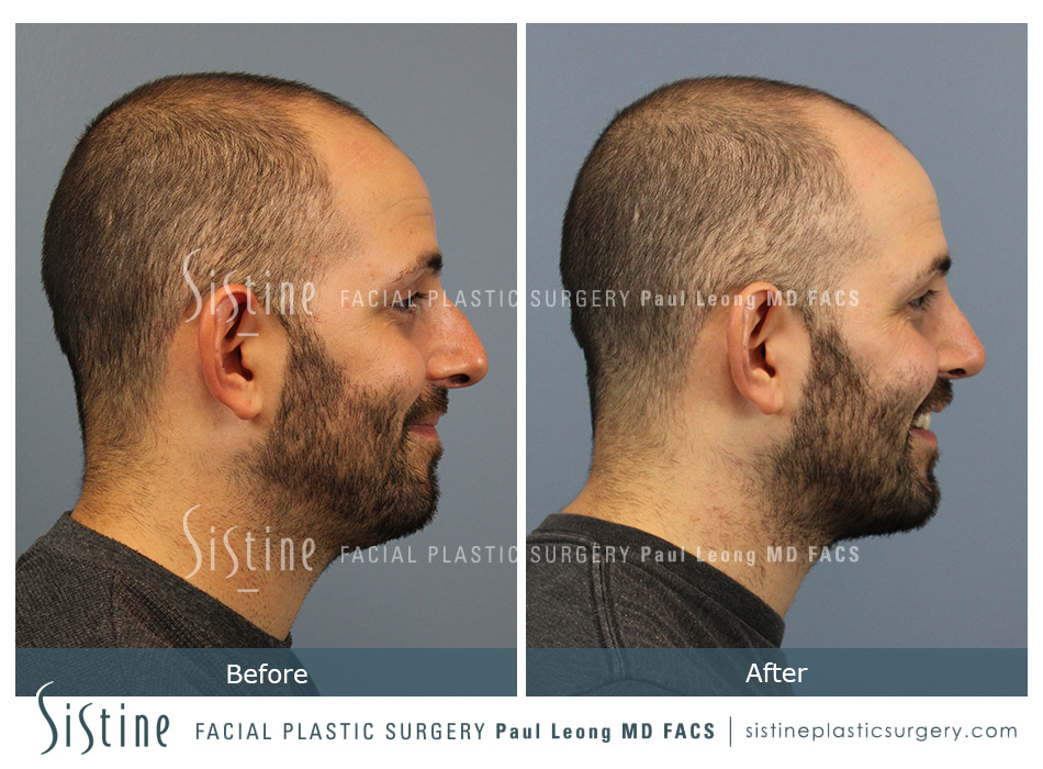 Rhinoplasty Functional - Left Lateral Preoperative View | Paul Leong MD