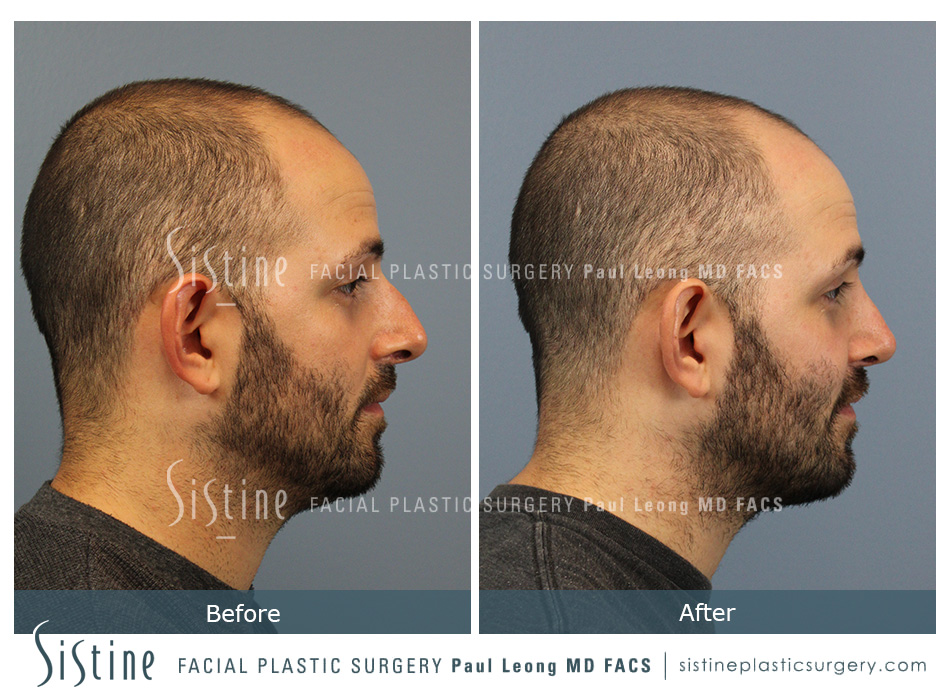 Nose Jobs Near Me (Pittsburgh ) - Left Lateral Preoperative View | Sistine Facial Plastic Surgery