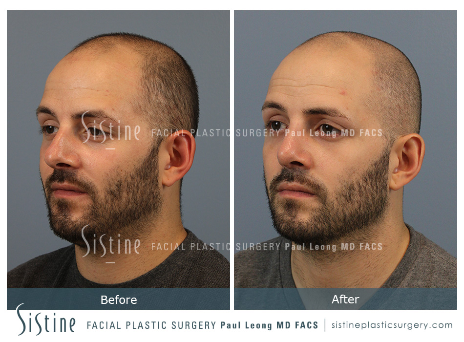 Nose Jobs Before and After in Pittsburgh - Basal View Preoperative | Dr. Paul Leong