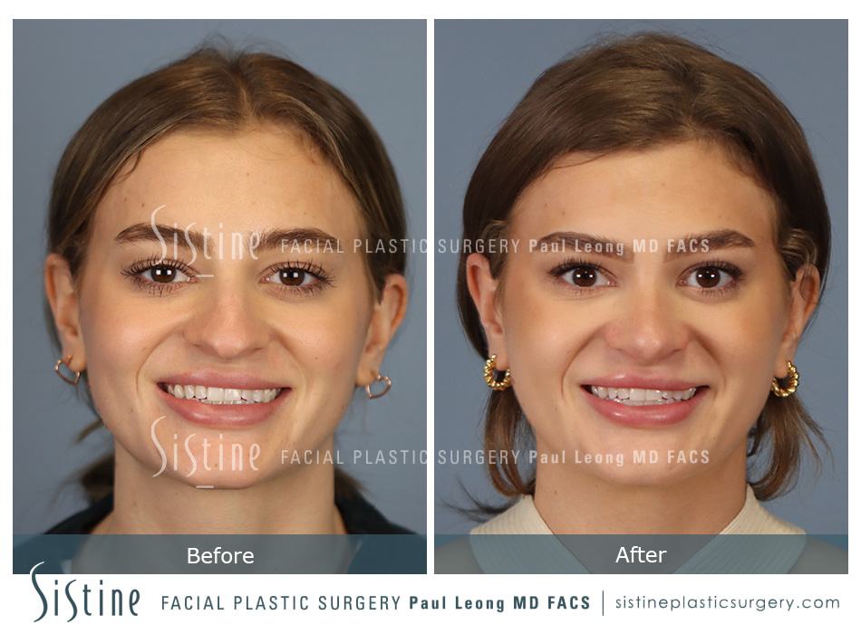 Best Pittsburgh Rhinoplasty - Preoperative Patient Less Oblique View | Paul Leong MD