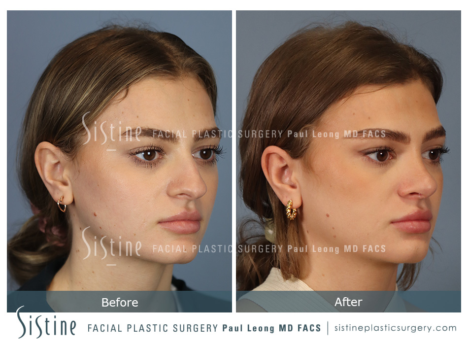 Pittsburgh Best Rhinoplasty Surgeon - Preoperative Basal View of Patient | Dr. Paul Leong