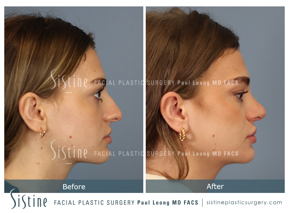 Best Rhinoplasty Nose Surgeon Pittsburgh - Patient Intra-Operative View  | Paul Leong MD
