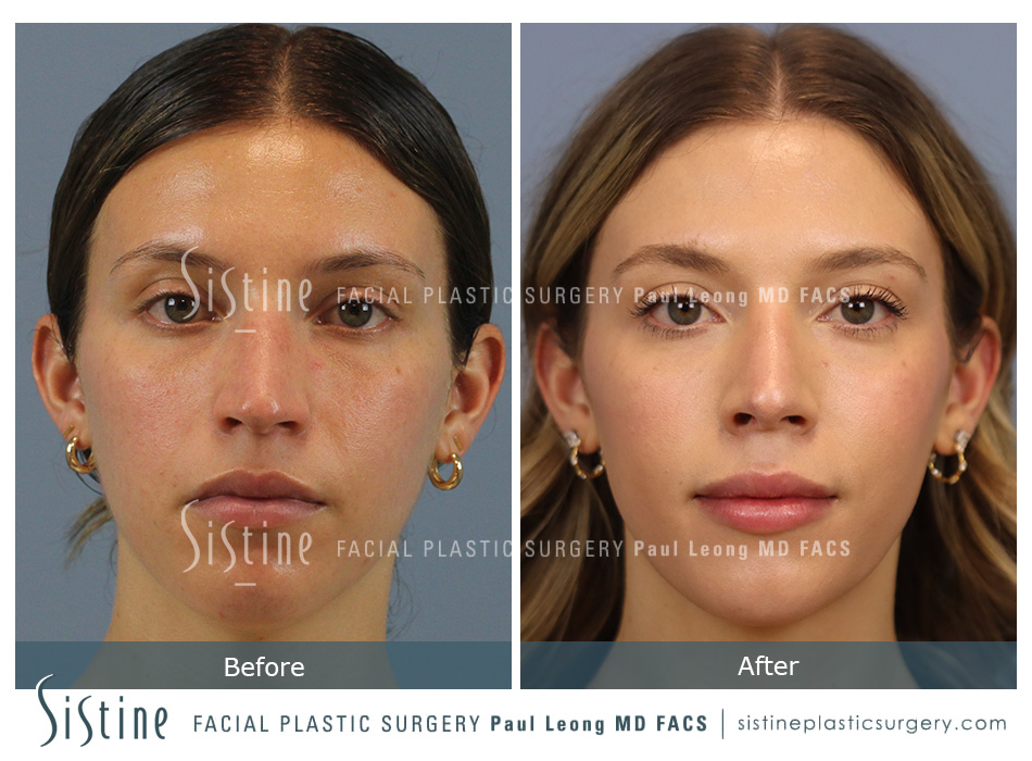 Top Rhinoplasty Surgeons in Pittsburgh - Preoperative Frontal View | Dr. Paul Leong