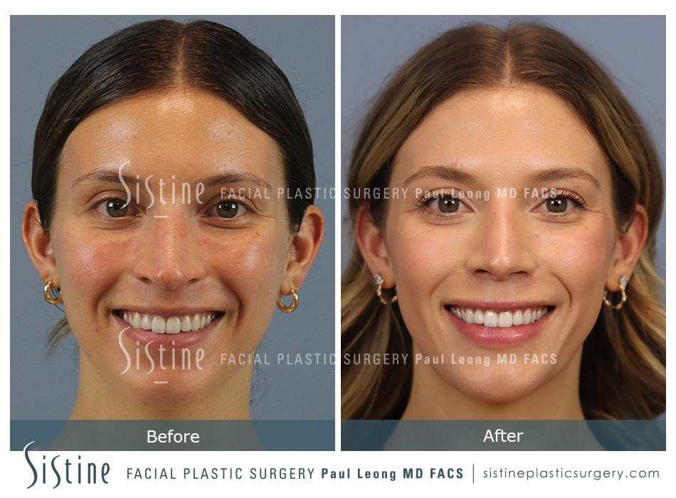 Rhinoplasty Surgery Pittsburgh - Preoperative View | Sistine Facial Plastic Surgery