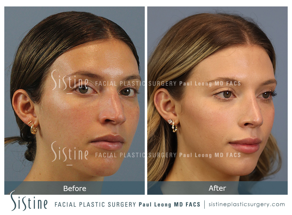 Best Rhinoplasty Surgeon in the World | Patient Preoperative Right Oblique Image | Dr. Paul Leong