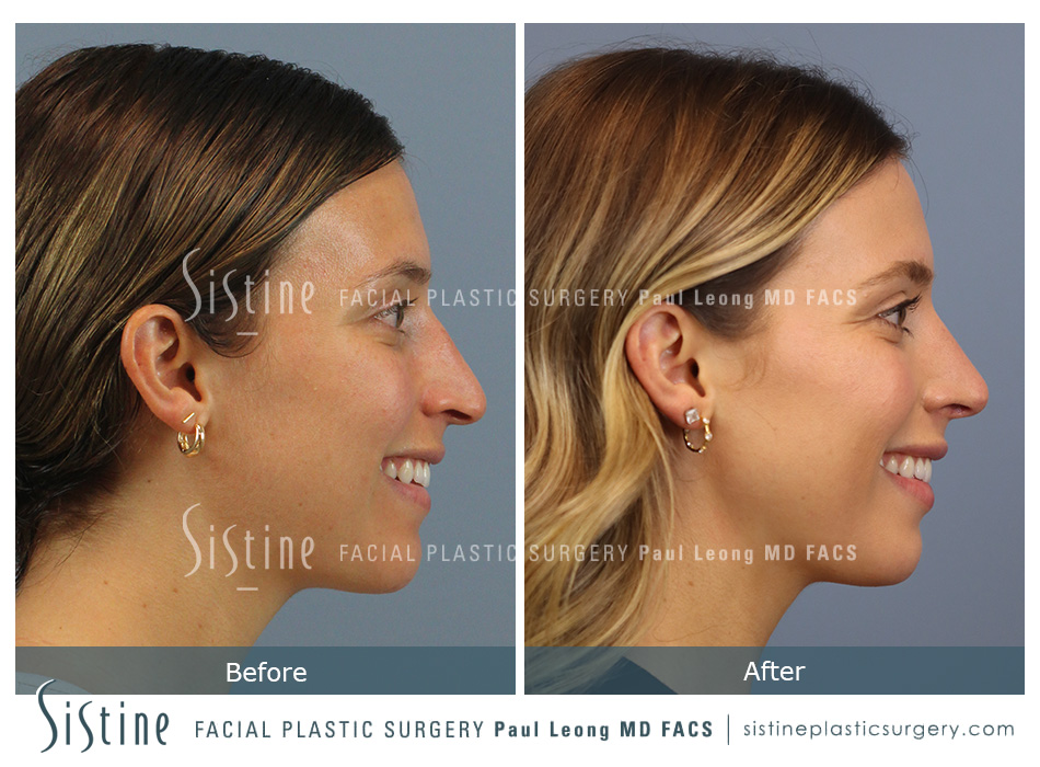 Rhinoplasty Surgery Southside Works - Preoperative View | Paul Leong MD