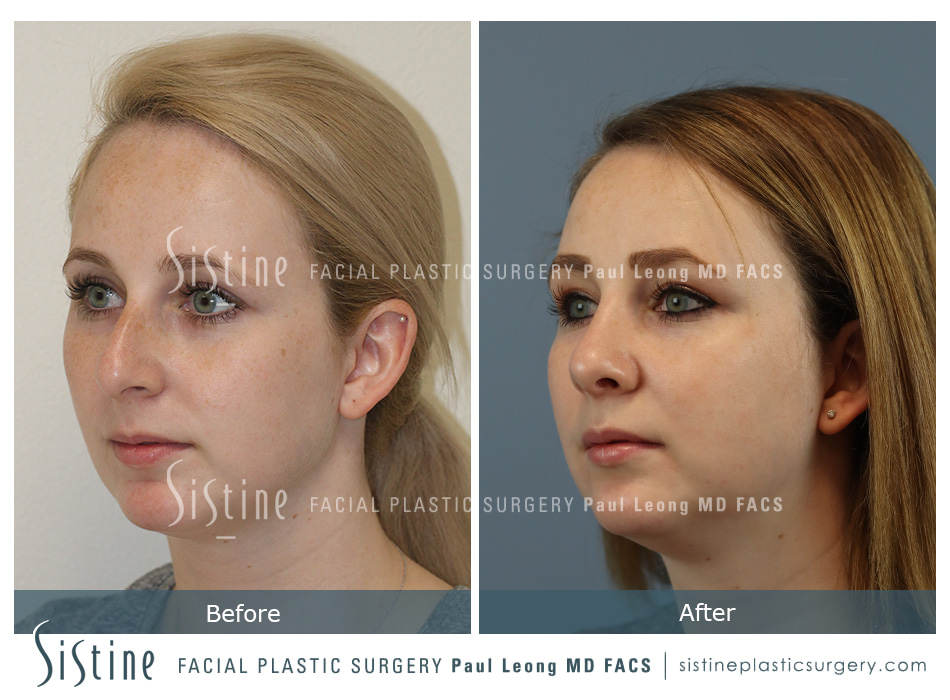 Rhinoplasty Before and After 14 Sistine Facial Plastic
