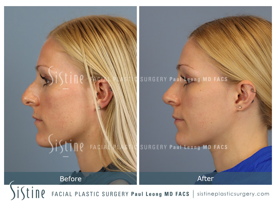 Droopy Nose Tip Surgery - Preoperative Left Lateral View | Dr. Paul Leong
