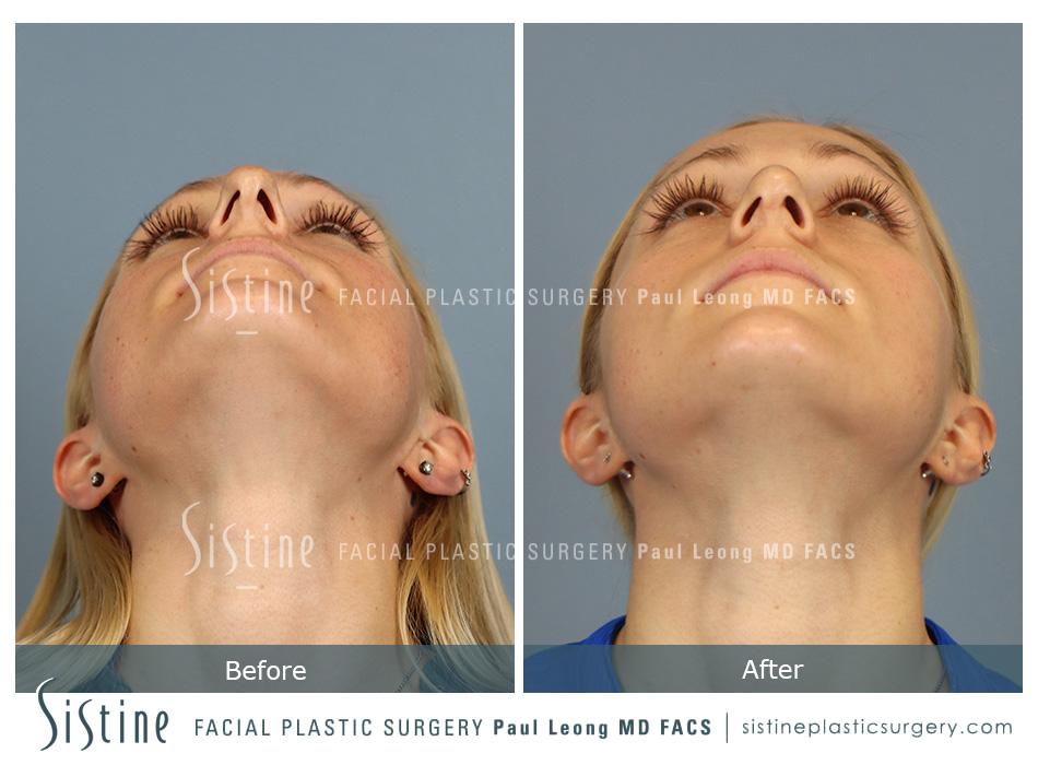 Upturned Nose Tip After Rhinoplasty - Preoperative Right Lateral View | Dr. Paul Leong