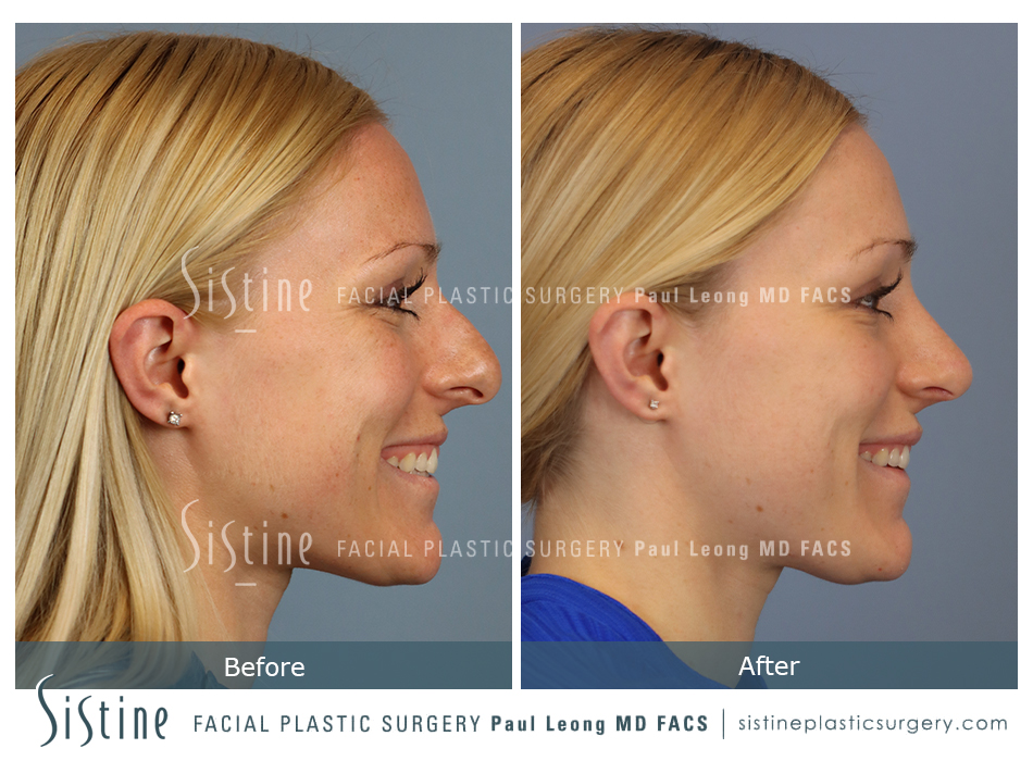 Drooping Nasal Tip Correction - Preoperative Right Lateral Smiling View | Dr. Leong, Pittsburgh 