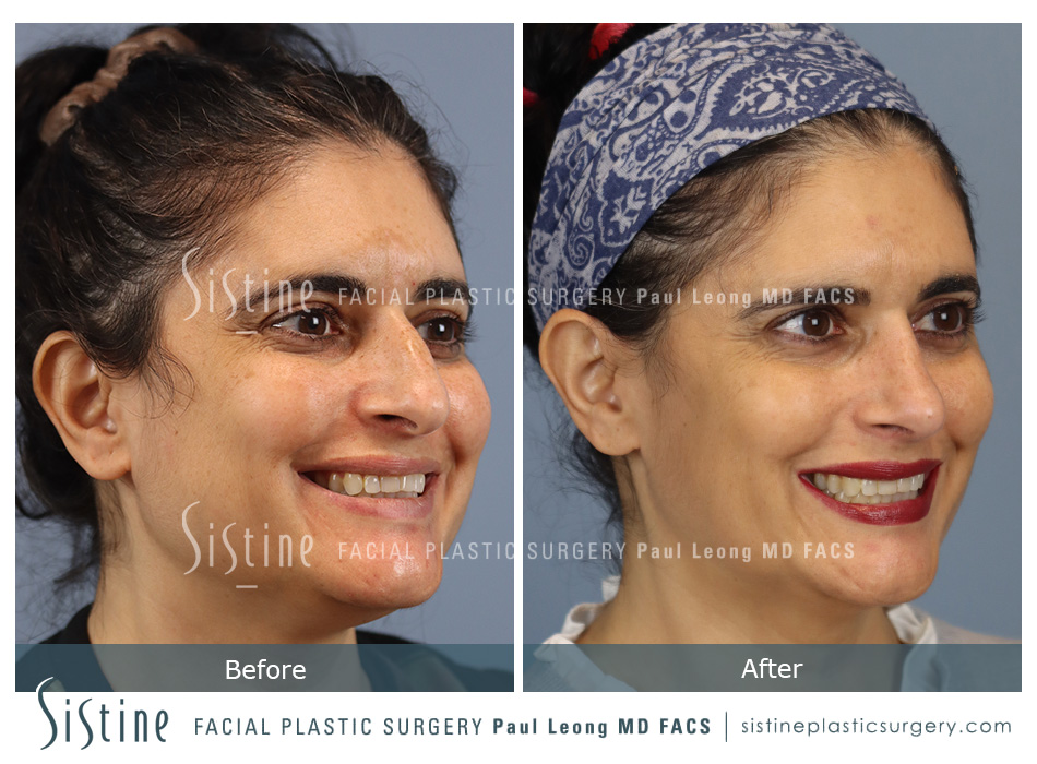 Rhinoplasty Surgery - Preoperative View | Sistine Facial Plastic Surgery