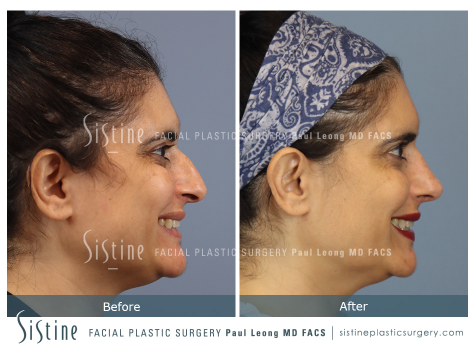 Nose Job for Men Pittsburgh | Preoperative Patient Image | Sistine Facial Plastic Surgery