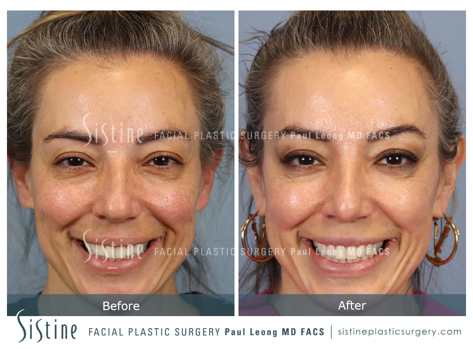 Pittsburgh Nose Reshaping Surgery - Preoperative Patient Image | Paul Leong MD