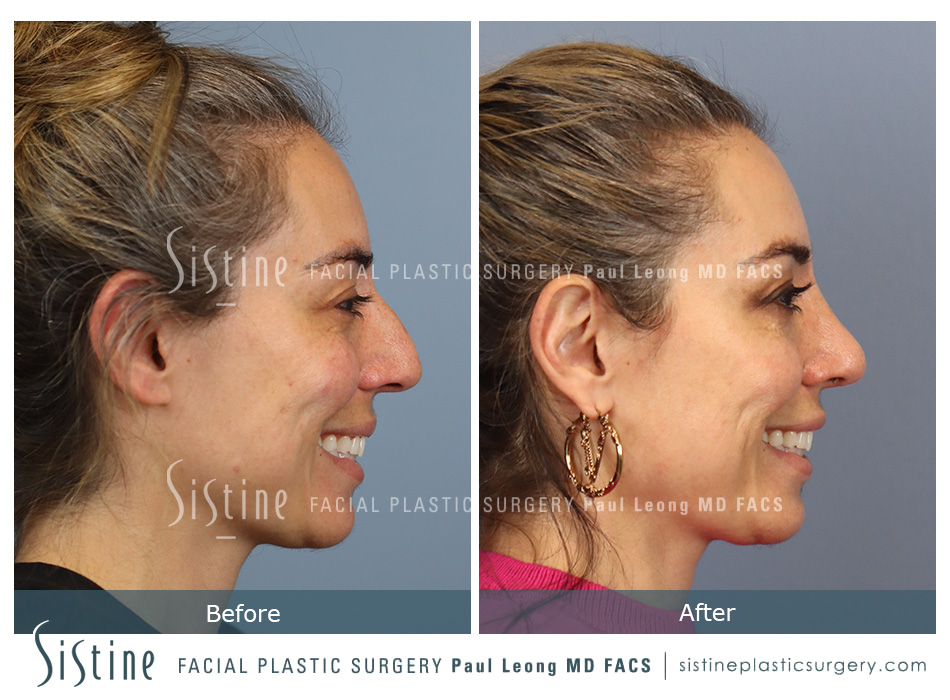 Rhinoplasty Surgery Wexford PA - Preoperative View | Sistine Facial Plastic Surgery
