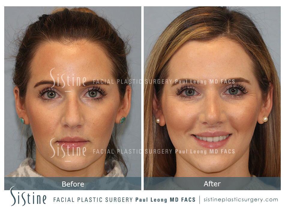Nasal Tip Rotation - Preoperative Image | Sistine Facial Plastic Surgery