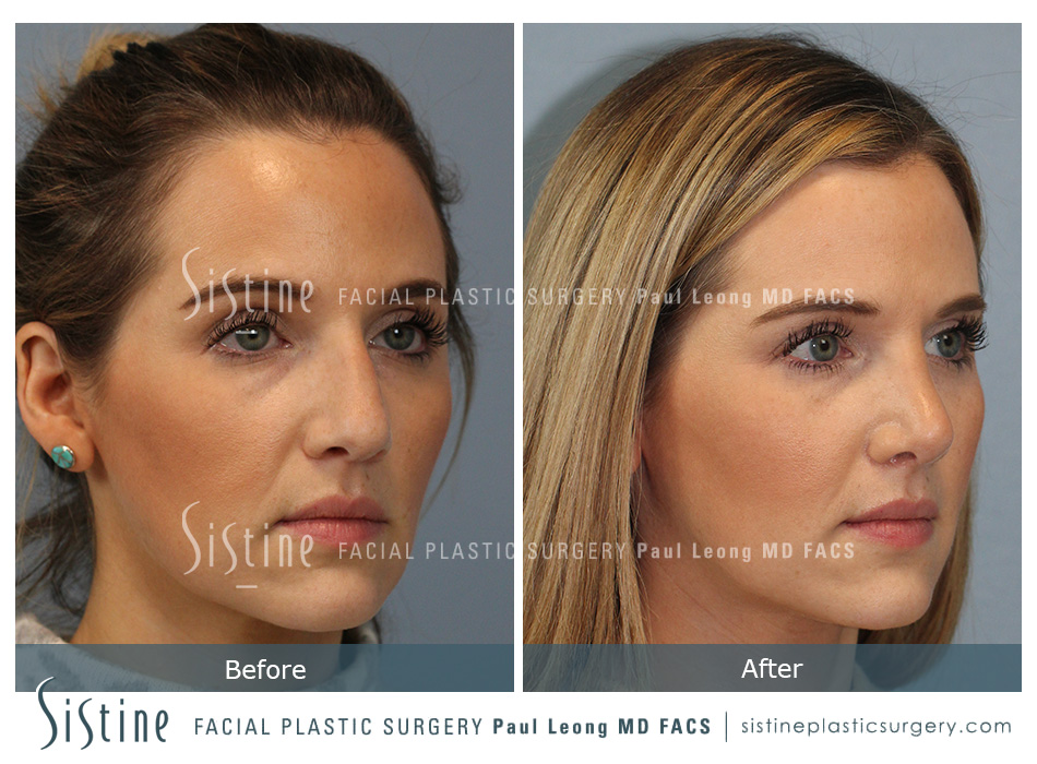 Supratip Break Rhinoplasty Pittsburgh - Preoperative Left Later View | Sistine Facial Plastic Surgery