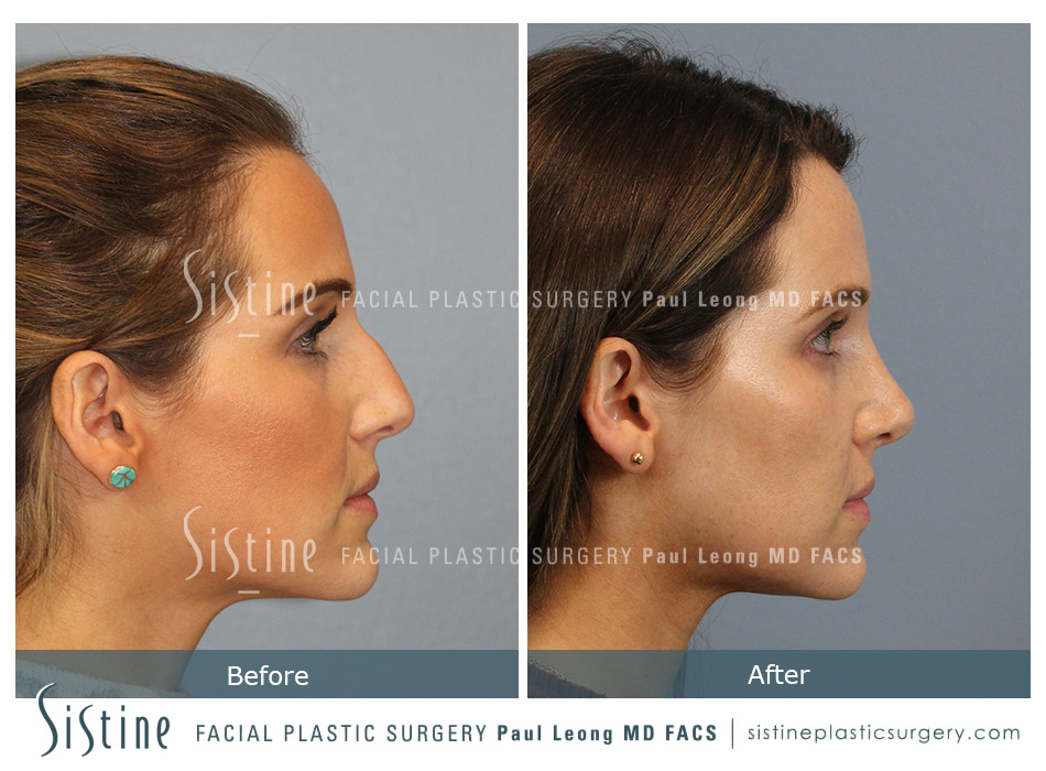 Pictures of Nose Jobs - Preoperative Left Oblique View | Dr. Paul Leong