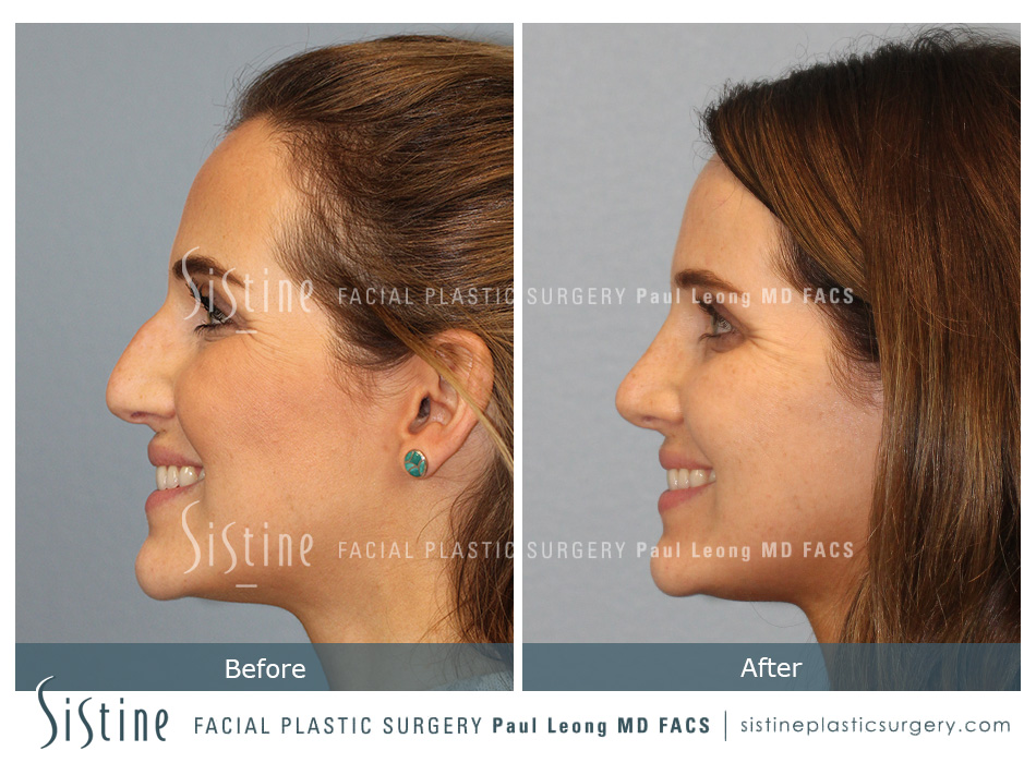 Restylane Dermal Fillers for Tear Trough - Before Treatment | Dr. Paul Leong, Pittsburgh PA