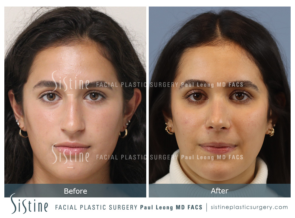 Pittsburgh Rhinoplasty Deviated Septum - Frontal Preoperative View | Sistine Facial Plastic Surgery 
