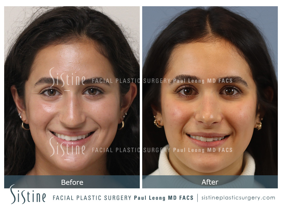 Nose Tip Refinement - Preoperative Frontal View | Dr. Paul Leong
