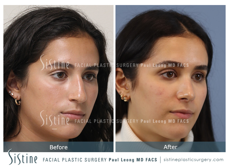 Functional Rhinoplasty Pittsburgh - Right Oblique Preoperative View | Dr. Paul Leong
