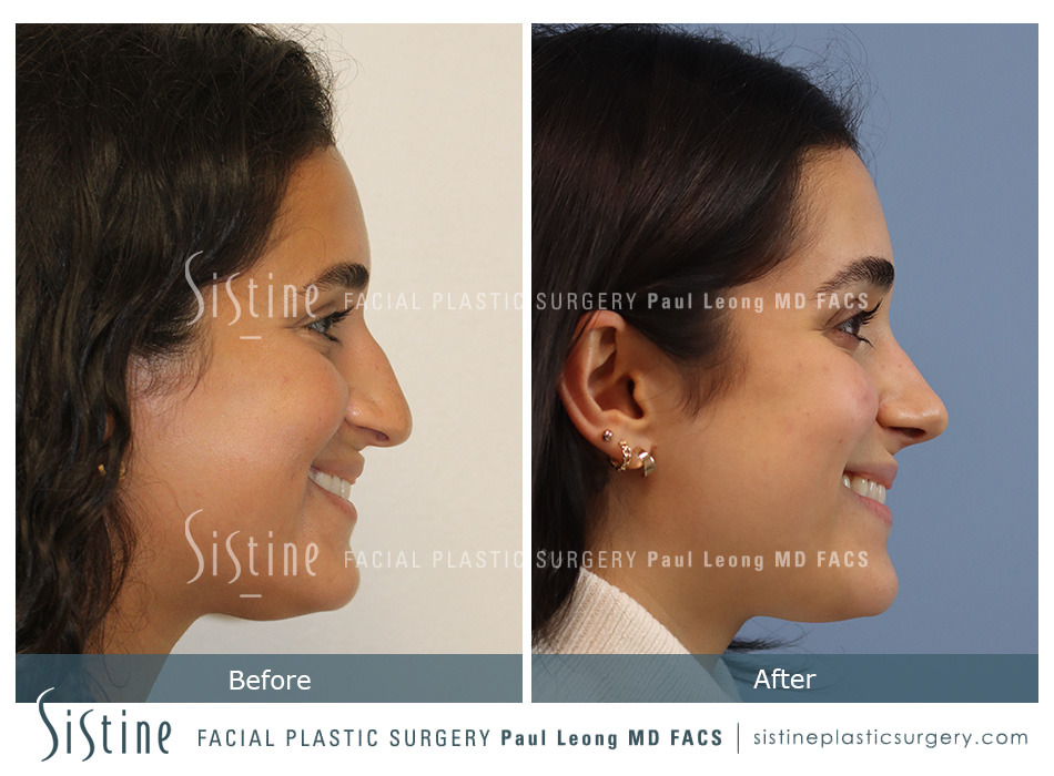 Septal Repair Nose Job - Right Lateral Preoperative View | Paul Leong MD