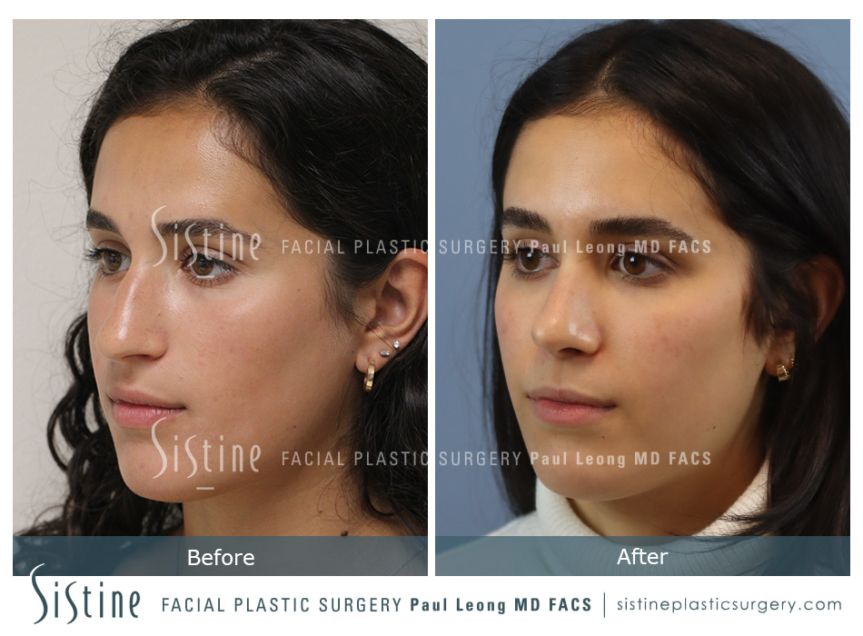 Septum Repair Nose Job - Preoperative Basal View | Dr. Paul Leong