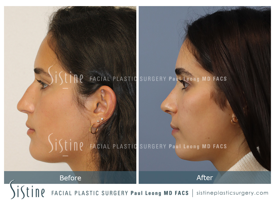 Drooping Nasal Tip Correction - Preoperative Right Lateral Smiling View | Dr. Leong, Pittsburgh 