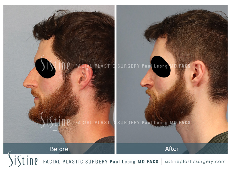 Best Rhinoplasty Surgeon Pittsburgh - Preoperative Patient Right Lateral View | Dr. Paul Leong