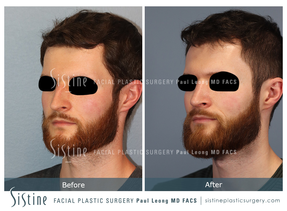 Best Pittsburgh Rhinoplasty - Preoperative Patient Less Oblique View | Paul Leong MD