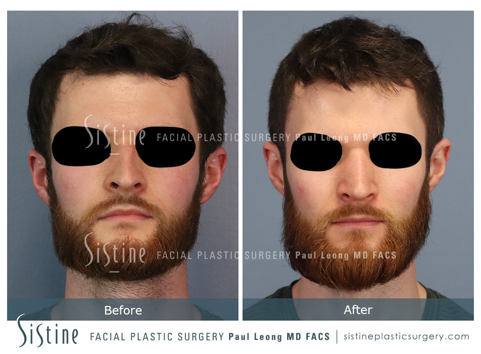 Pittsburgh Mens Nose Surgery - Patient Preoperative View | Paul Leong MD