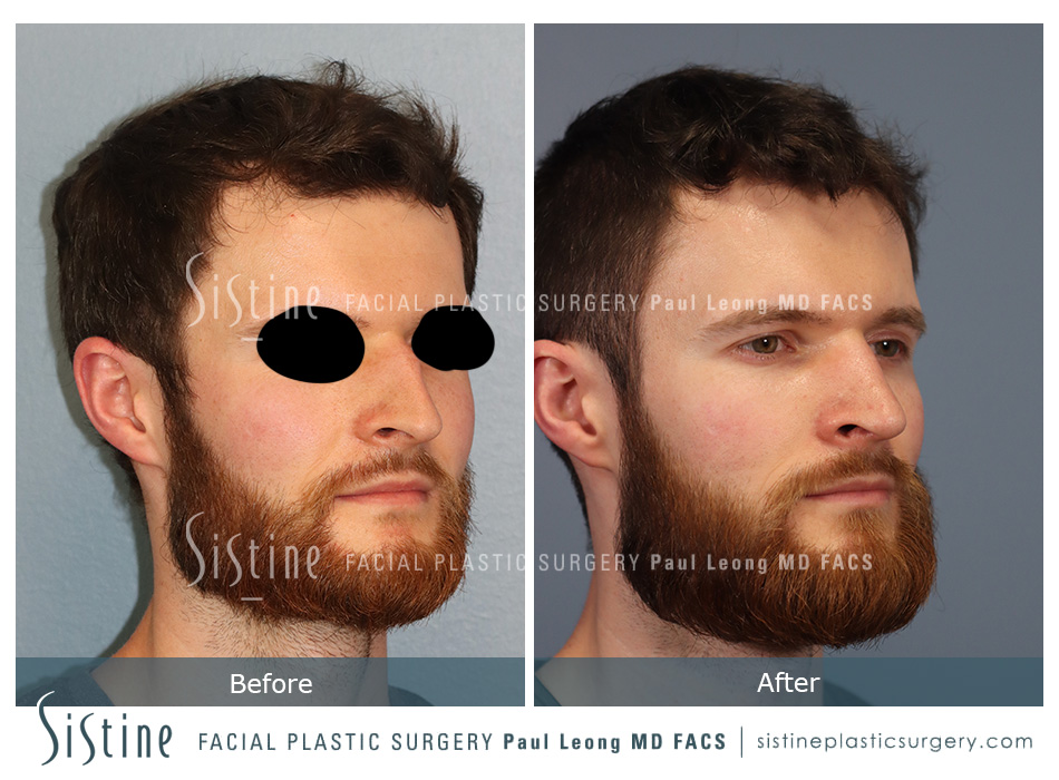Rhinoplasty Functional - Left Lateral Preoperative View | Paul Leong MD