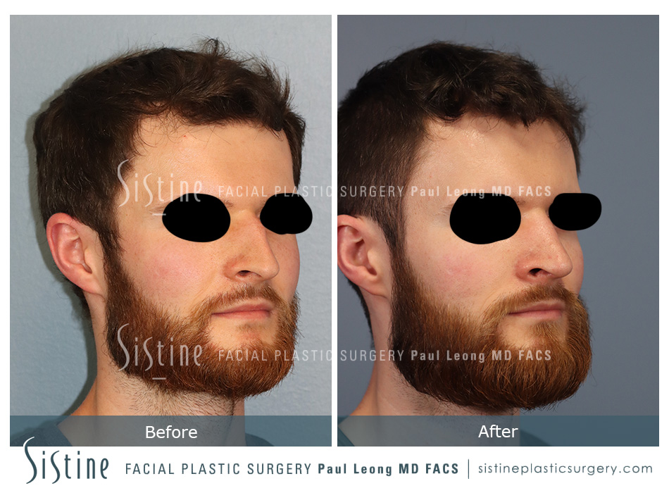 Septal Repair Nose Job - Right Lateral Preoperative View | Paul Leong MD