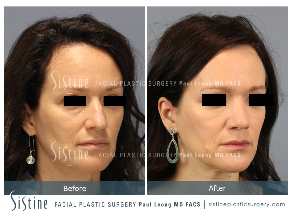Best Rhinoplasty Surgeon in the World | Patient Preoperative Right Oblique Image | Dr. Paul Leong