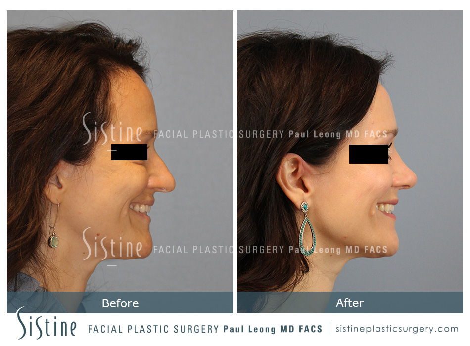 Pittsburgh Rhinoplasty Surgeon - Preoperative Patient Right Lateral View | Paul Leong MD