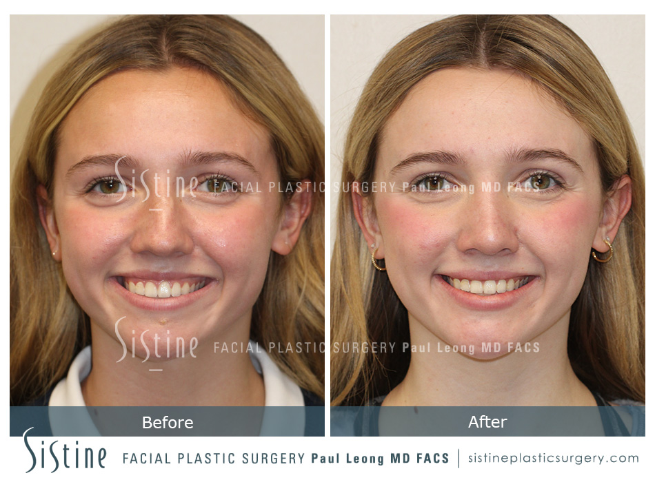 Rhinoplasty Sewickley PA - Preoperative Patient View | Dr. Paul Leong